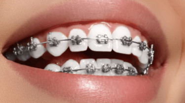 Dental braces treatment