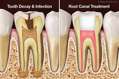 Root canal treatment in visakhapatnam