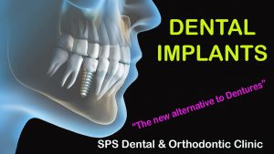 Dental Implants -