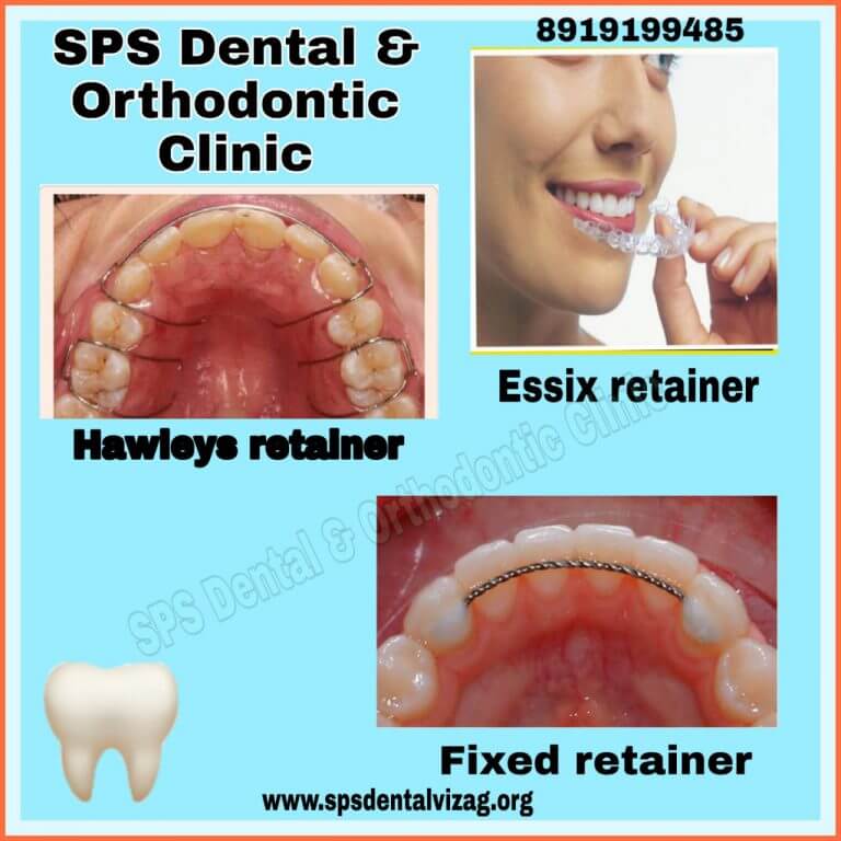 Retainers after braces treatment... ??SPS Dental & Orthodontic clinicvizag