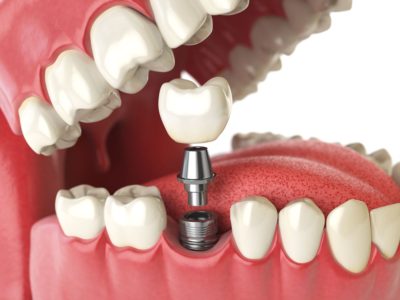 Dental Implants in vizag