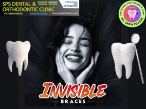 invisible braces